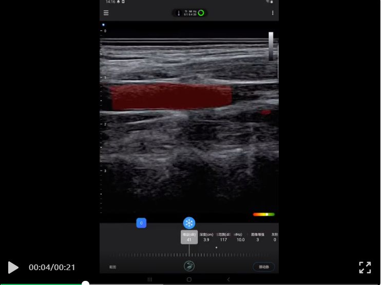 Congratulate! Amain MagiQ handheld Ultrasound Adds New Technology-Automatic Screening of Carotid Plaque