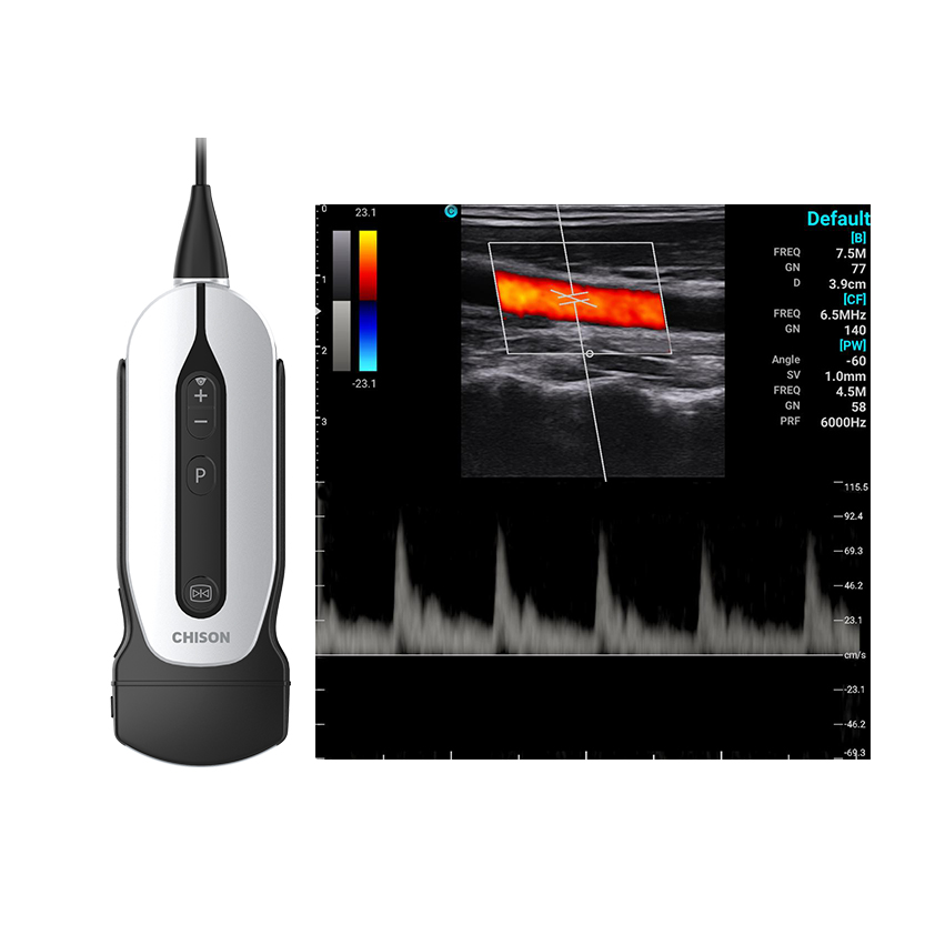 Sıcak satış CHISON SonoEye serisi p1 su geçirmez ve taşınabilir renkli doppler ultrason cihazı