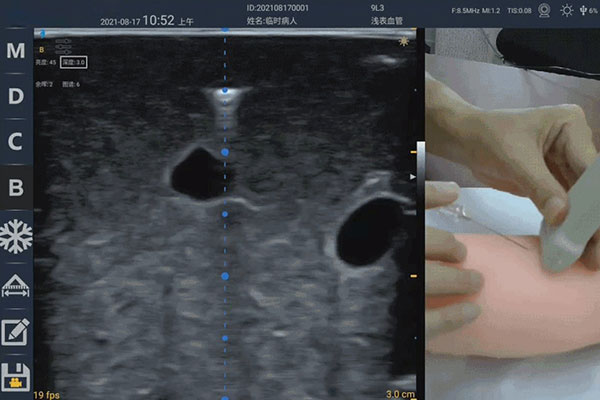 Manifestation and concealment of puncture needle under ultrasound