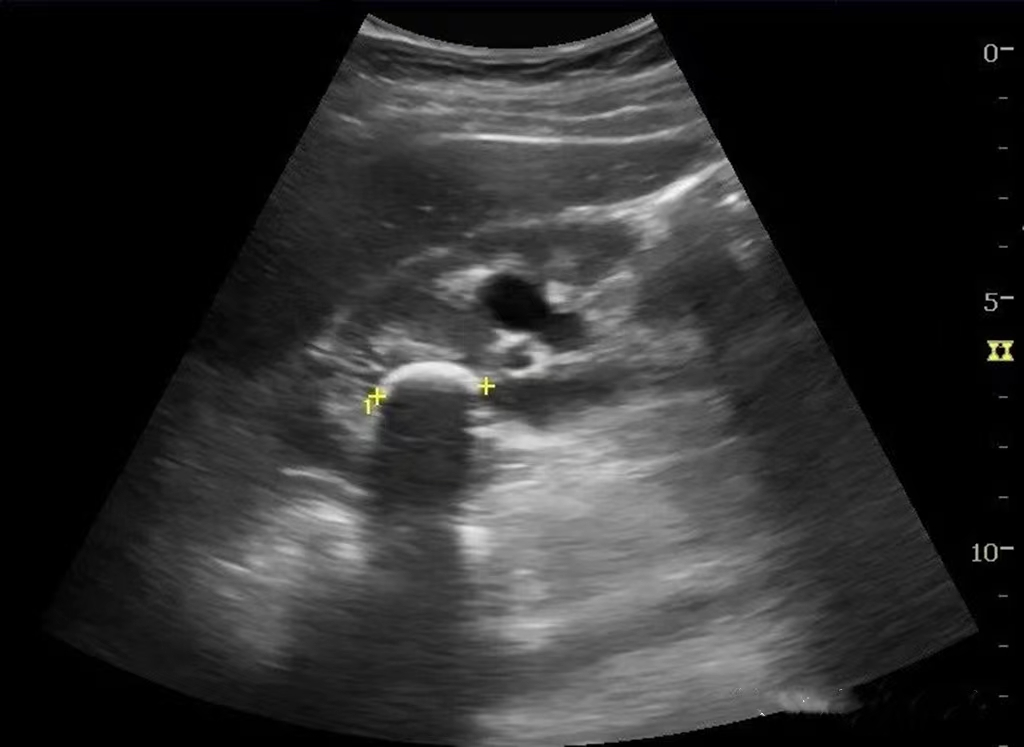 How the doctors to better use the ultrasound sound and shadow to do kidney stone gallstone scan?