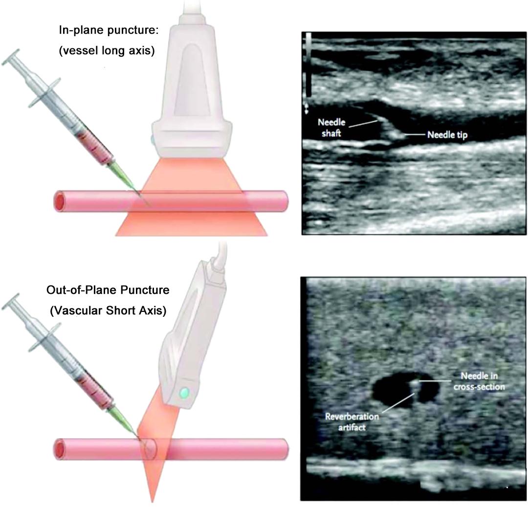 How to use visualization to improve ultrasound puncture technology?