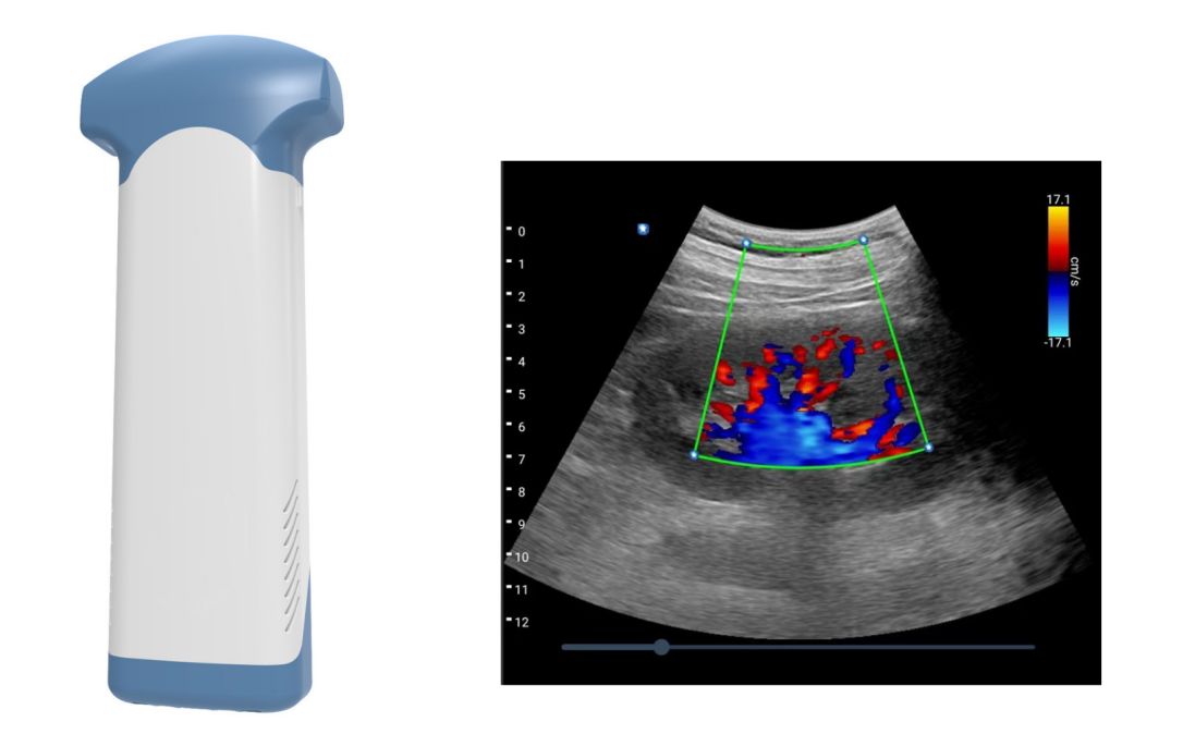 Application of handheld ultrasound
